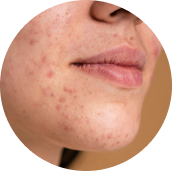 Acné y rosácea