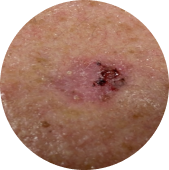 Cáncer de piel y melanoma