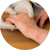 Psoriasis y dermatisis