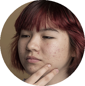 Acné juvenil