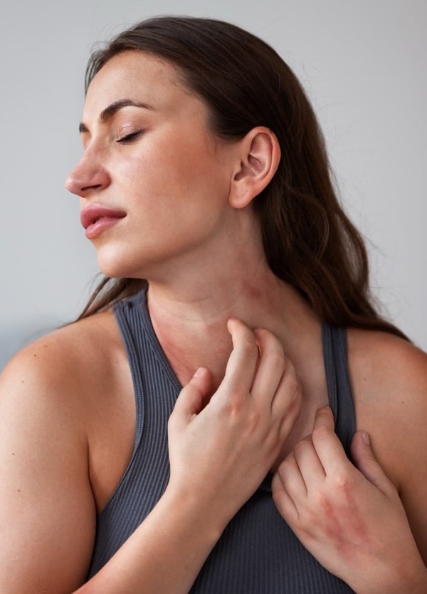 Chica con Dermatitis