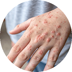 Dermatitis dishidrotica