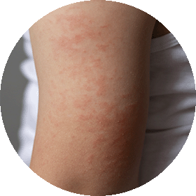 Dermatitis por contacto