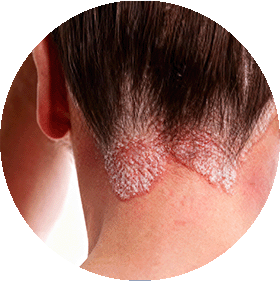 Dermatitis Seborreica
