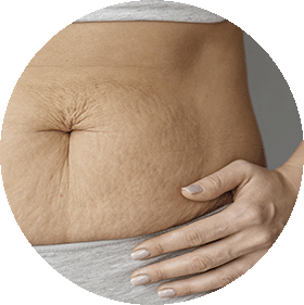 Flacidez en zonas localizadas