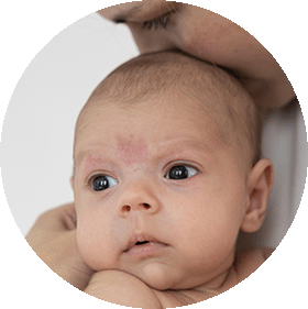 Manchas de nacimiento 