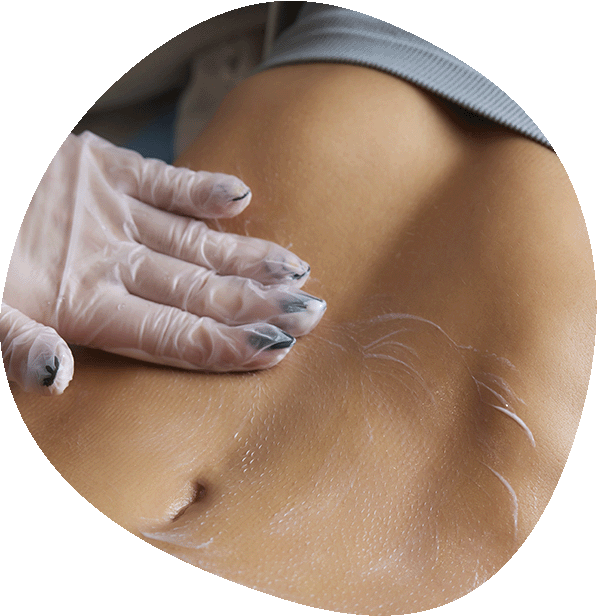 Mesoterapia corporal en Luma Clinique, Alicante