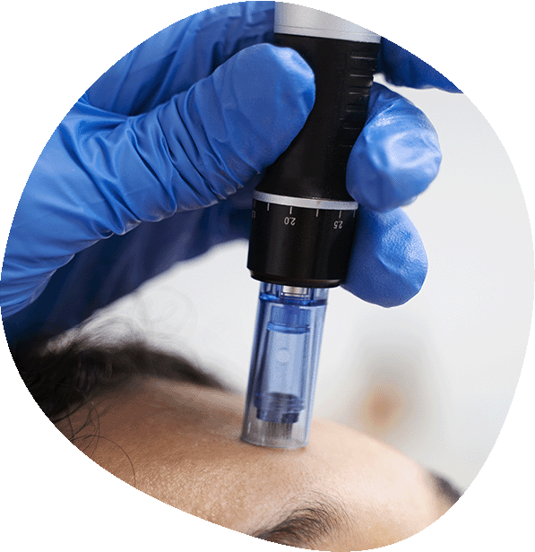 Microneedling en Luma Clinique, Alicante