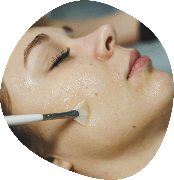 Tratamiento de peeling químico en Alicante, Luma Clinique