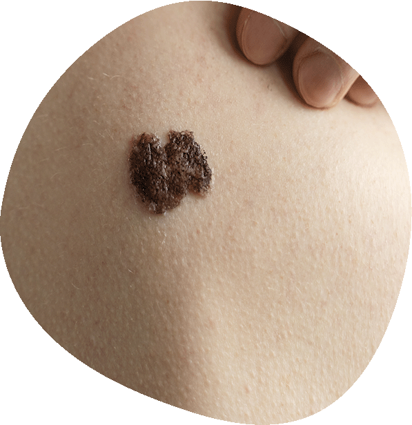 Diagnóstico y tratamiento de cáncer de piel y melanoma en Luma Clinique