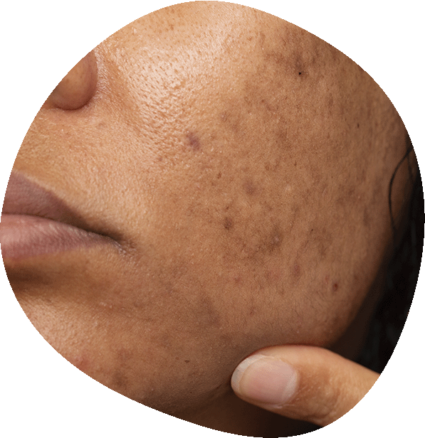 Tratamiento de melasma y alteraciones pigmentarias en Luma Clinique