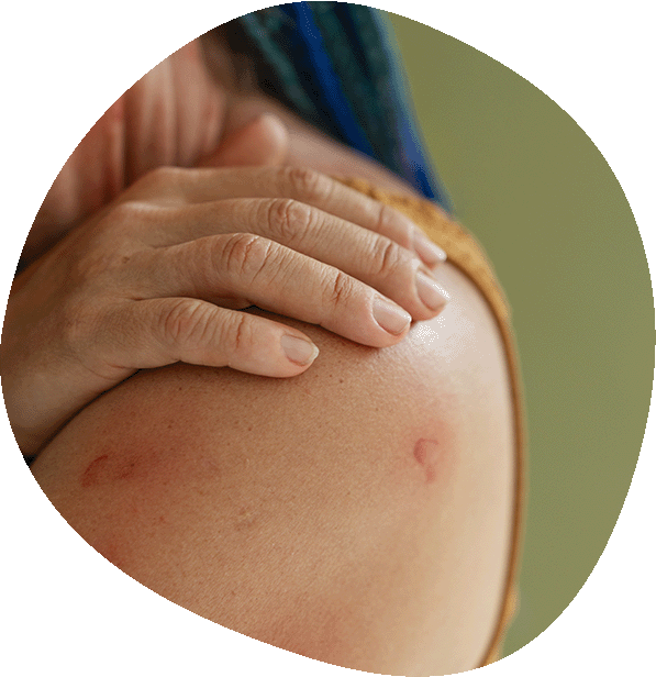 Tratamiento de Dermatitis en Luma Clinique en Alicante