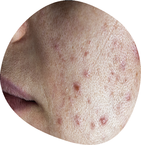 Tratamiento de rosácea y acné en Alicante