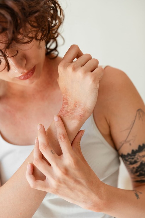 Chica tratando la dermitis que padece