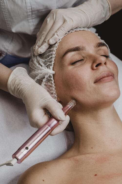 Preguntas frecuentes sobre microneedling en Alicante, Luma Clinique