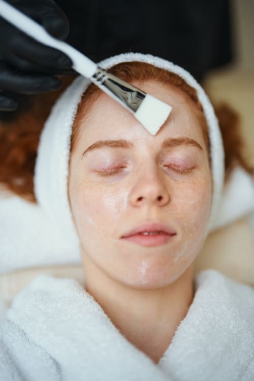 Preguntas frecuentes sobre el peeling químico en Alicante