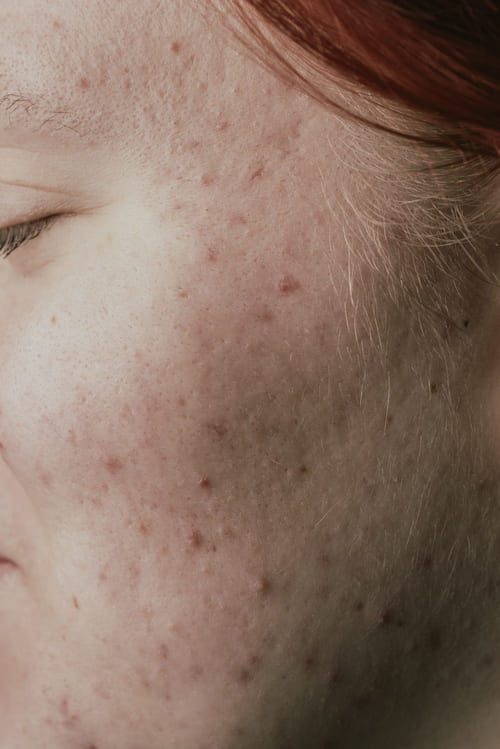 Preguntas frecuentes sobre el tratamiento de Rosácea y Acné