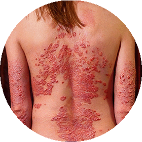Psoriasis Eritrodermia