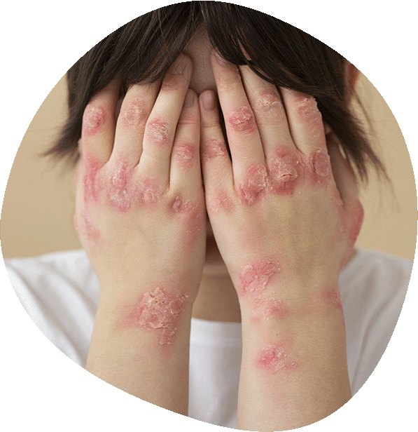 Tratamiento de psoriasis en Alicante, Luma Clinique