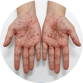 Psoriasis pustulosa