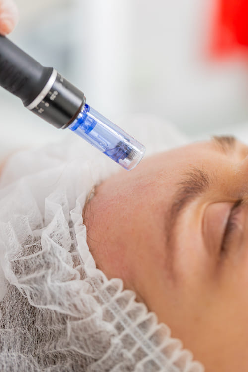 Beneficios que ofrece el microneedling en Alicante