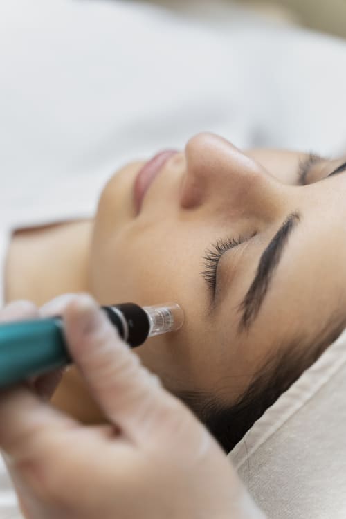 Tratamiento del microneedling en Alicante