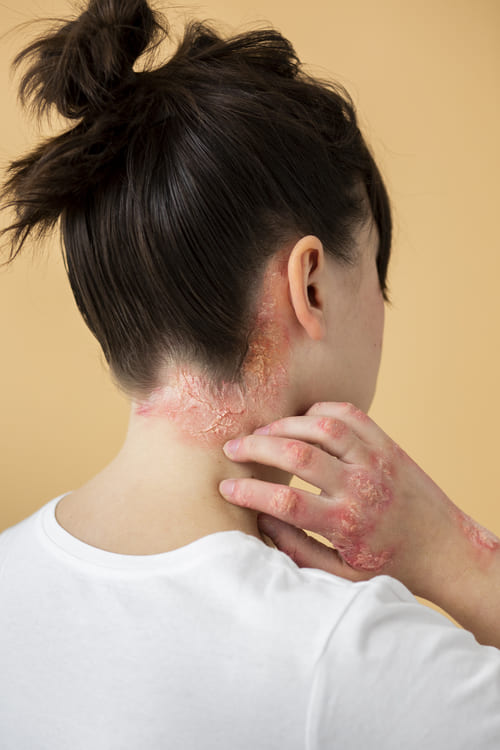 Psoriasis en Alicante, Luma Clinique