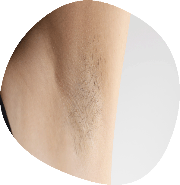 Tratamiento de hiperhidrosis en Luma Clinique, Alicante