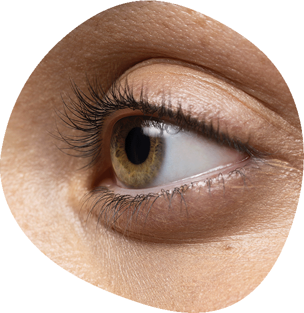 Tratamiento de Ojeras en Luma Clinique, Alicante