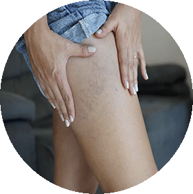 Tratamiento de varices