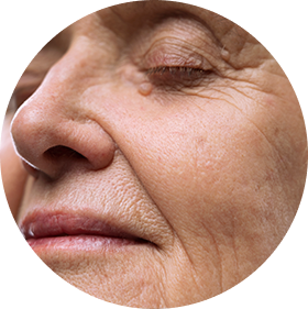 Eliminación de estrías y marcas