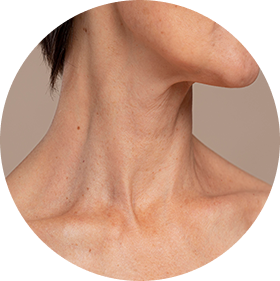 Eliminación de estrías y marcas