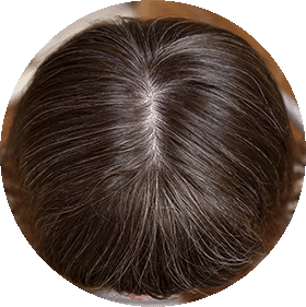 Manchas y alteraciones de la pigmentación