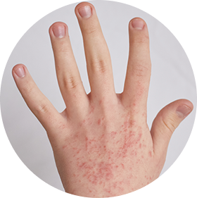 Dermatología venereológica (ETS)