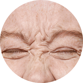 Eliminación de estrías y marcas