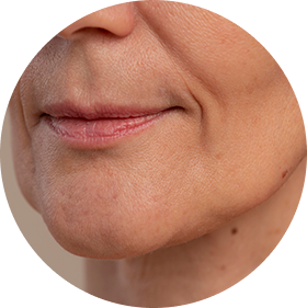 Eliminación de estrías y marcas