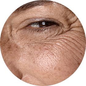 Eliminación de estrías y marcas